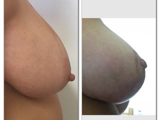 Mastopessi con cicatrice verticale