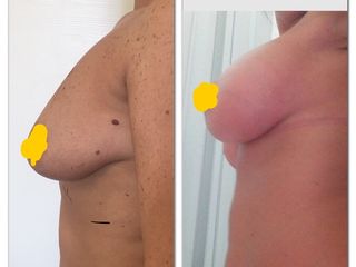 Mastopessi round block, con protesi