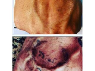 Rimozione tatuaggi - Dott. Giancarlo Delli Santi