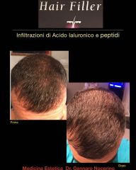 Acido ialuronico - Dott. Gennaro Nocerino