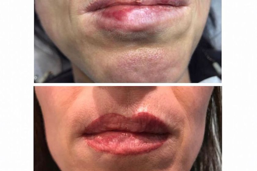 Dermopigmentazione prima e dopo - 850965