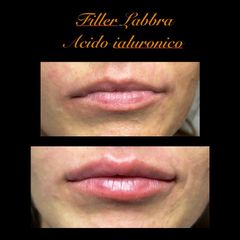 Filler Labbra - tecnica Paris Lip - Dott. Gennaro Nocerino