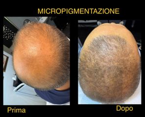 Dott. Gennaro Nocerino micropigmentazione