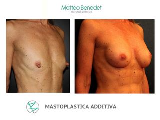mastoplastica additiva prima dopo