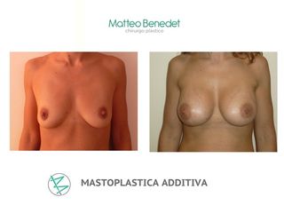 mastoplastica additiva prima dopo