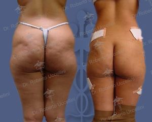 Liposcultura prima e dopo