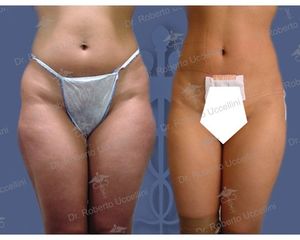Liposcultura prima e dopo