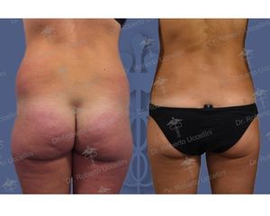 Liposcultura prima e dopo