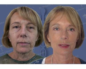 Lifting e blefaroplastica prima e dopo