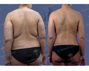 Liposcultura prima e dopo