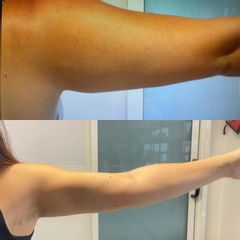 Liposuzione braccia - Dr. Felice E Dr. Patrizio Cardone