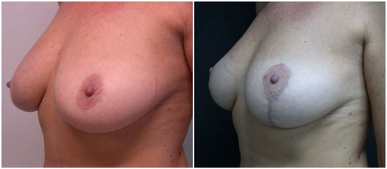 Mastopessi - Dr. Felice E Dr. Patrizio Cardone