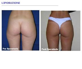 Liposuzione prima e dopo