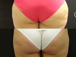 Trattamento culotte prima dopo
