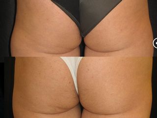 Trattamento culotte prima dopo