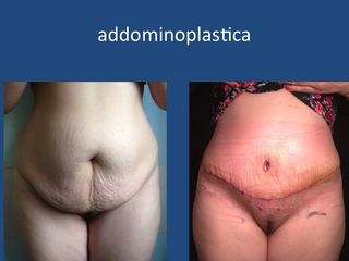 Addominoplastica prima dopo
