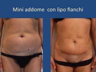 Mini Addominoplastica prima dopo