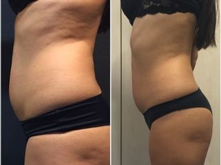 adiposità localizzata e cellulite prima dopo