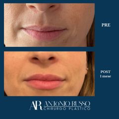 Filler labbra con correzione asimmetria - Dott.Antonio Russo