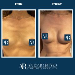 Mastoplastica additiva con correzione mammella tuberosa - Dott.Antonio Russo