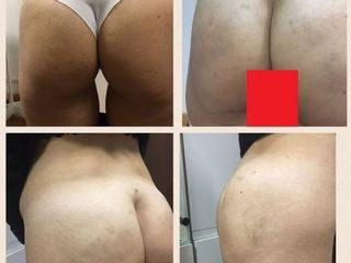 Gluteoplastica non chirurgica prima dopo