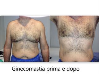 Ginecomastia prima dopo
