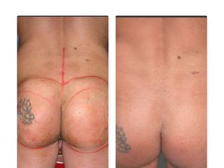 gluteoplastica prima dopo
