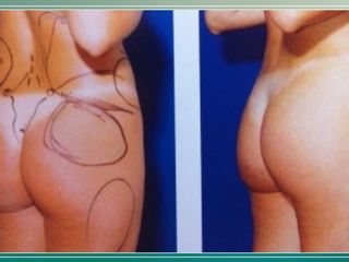 liposuzione prima dopo