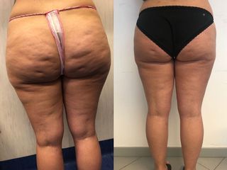 liposcultura prima dopo