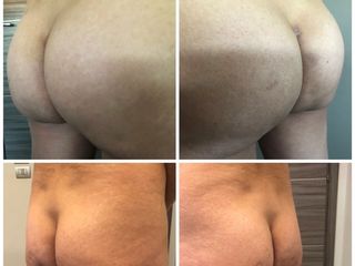 Gluteoplastica non chirurgica prima dopo
