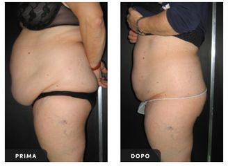 Liposuzione - Dott. Ugo Majani