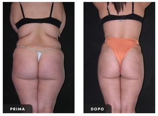 Liposuzione - Dott. Ugo Majani