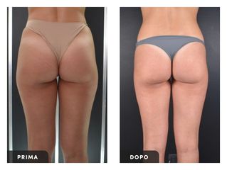 Liposuzione - Dott. Ugo Majani