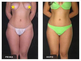 Liposuzione - Dott. Ugo Majani