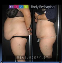 Liposuzione vaser addome - Dott. Ugo & Aldo Majani - MIAS Medical Center