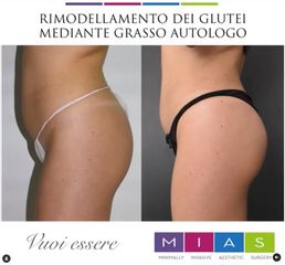 Lipofilling Glutei - Dott. Ugo & Aldo Majani - MIAS Medical Center