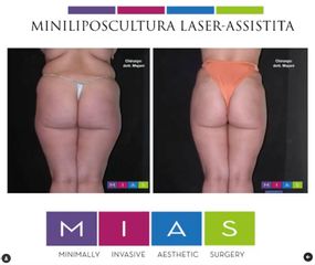 Miniliposcultura laser - Dott. Ugo & Aldo Majani - MIAS Medical Center