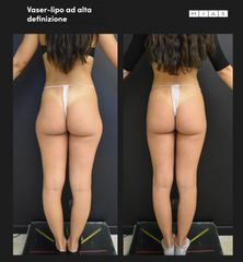 Vaser lipo - Dott. Ugo & Aldo Majani - MIAS Medical Center