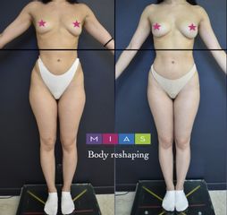 Lipofilling Seno - Dott. Ugo & Aldo Majani - MIAS Medical Center