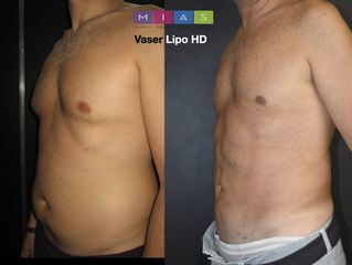 Vaser Lipo ad alta definizione - Dott. Ugo & Aldo Majani - MIAS Medical Center