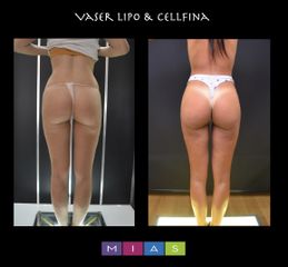 Vaser lipo Cellfina - Dott. Ugo & Aldo Majani - MIAS Medical Center