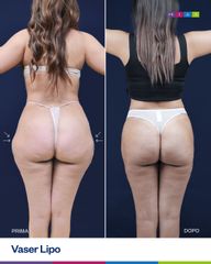 Dott. Ugo & Aldo Majani - MIAS Medical Center Vaser Lipo