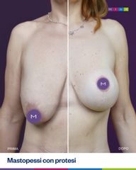 Dott. Ugo & Aldo Majani - MIAS Medical Center Mastopessi con protesi