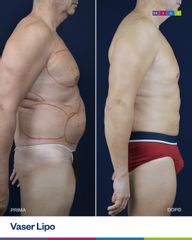 Dott. Ugo & Aldo Majani - MIAS Medical Center Vaser Lipo