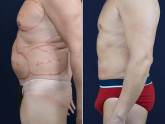 Lipo Vaser prima e dopo - 873047