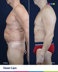 Dott. Ugo & Aldo Majani - MIAS Medical Center Vaser Lipo