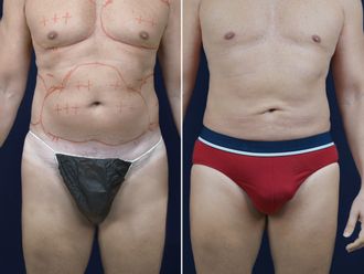 Lipo Vaser prima e dopo - 873048
