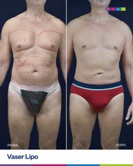 Dott. Ugo & Aldo Majani - MIAS Medical Center Vaser Lipo
