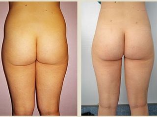 Liposuzione prima e dopo