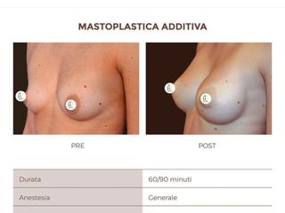 Mastoplastica addittiva pre e post trattamento